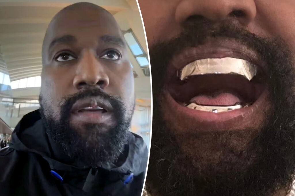 Kanye West’s lip ‘growth’ made more prominent by his $850K titanium ...